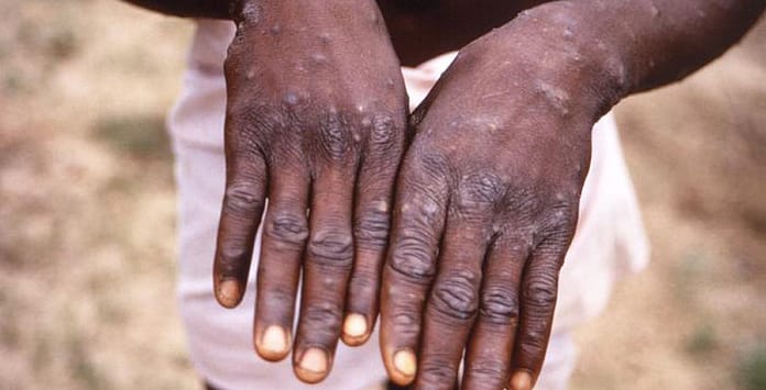 More than 700 monkeypox cases globally, 21 in US: CDC