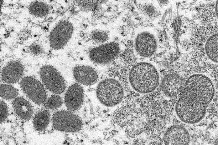 Saskatchewan health officials confirm first case of monkeypox in province