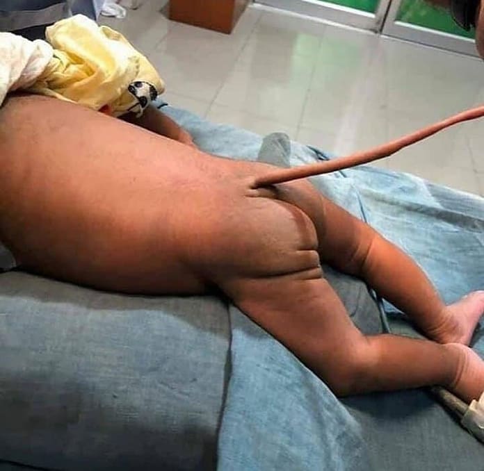 Reactions As Photos Of Baby Born With A Tail Hit The Internet